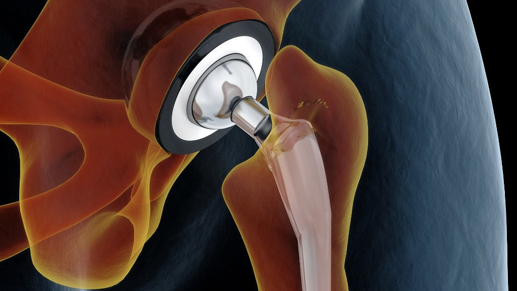 Hip implant or replacement surgeries are done to replace the hip joint with a prosthetic joint.