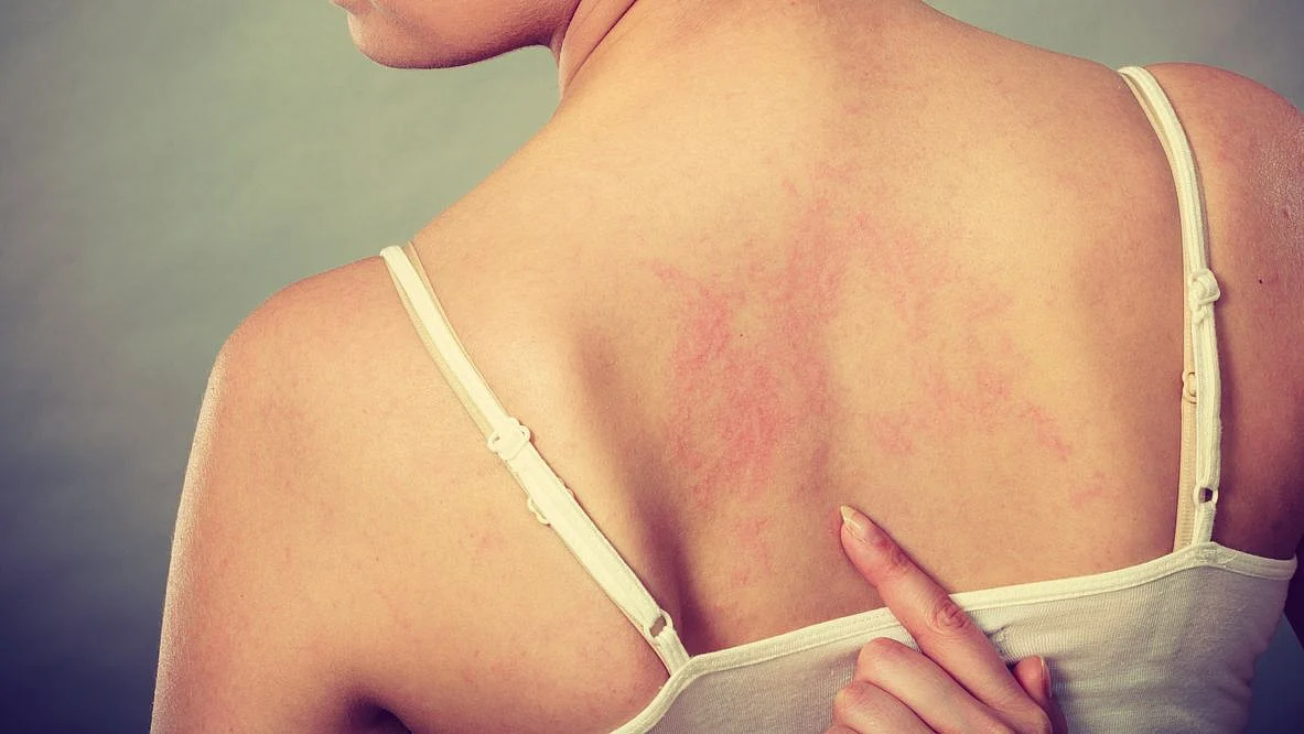 Being Allergic to Water Is a Real Thing and There’s No Cure Either