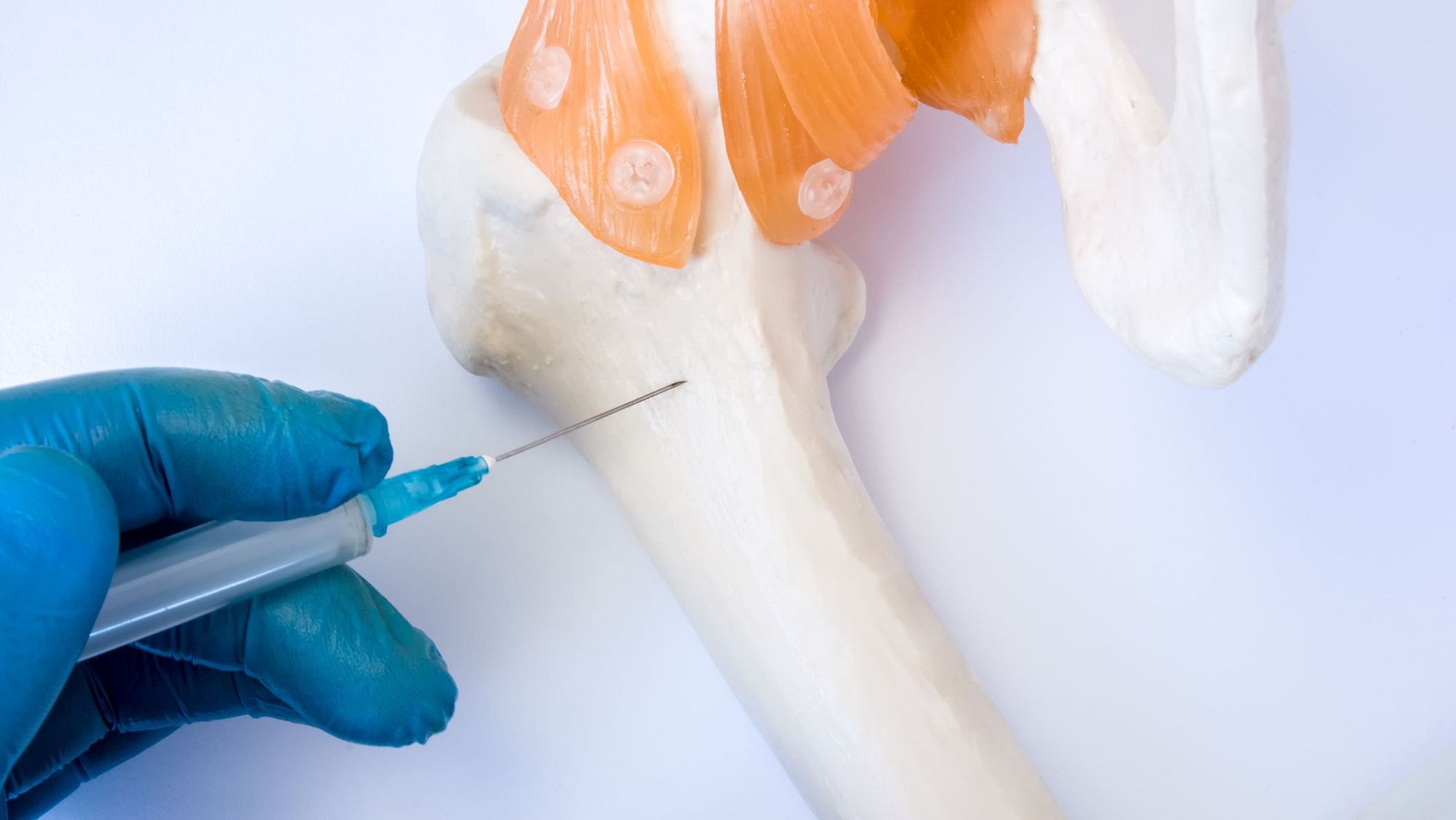 Bone marrow harvesting involves a procedure during which stem cells are collected with a needle placed into the soft centre of the bone.