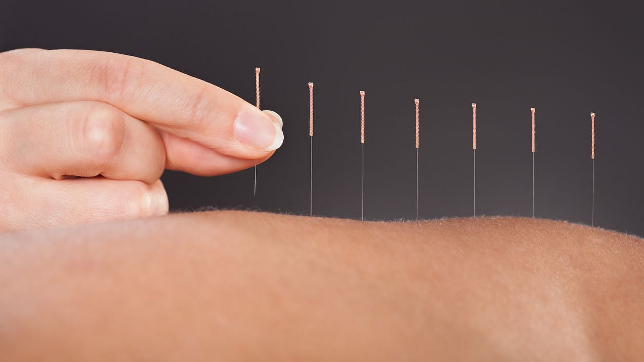 Hari acupuncture involves leaving needles permanently under the skin in the belief they relieve pain.