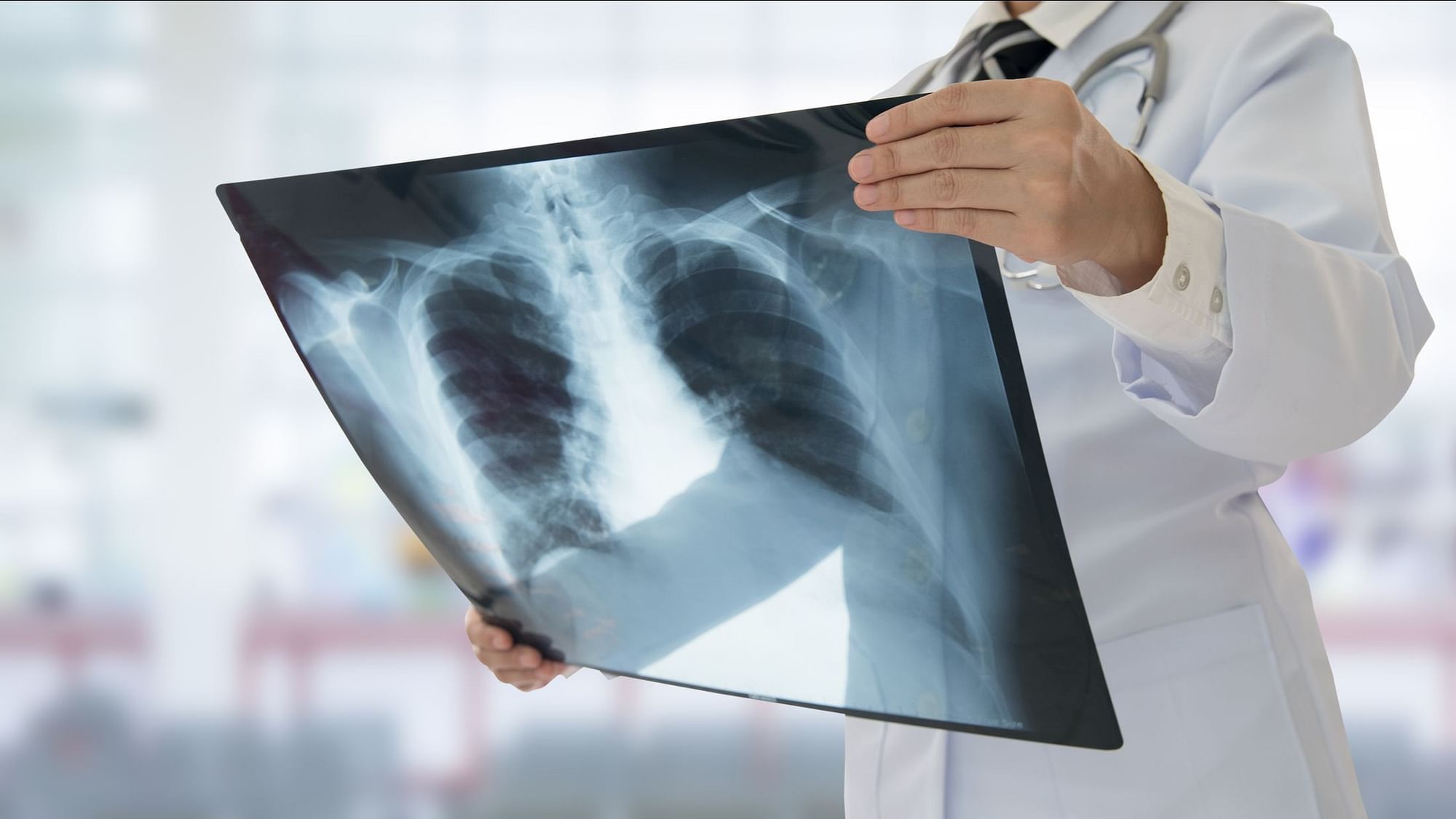 Researchers Develop AI to Detect COVID on Chest X-Rays