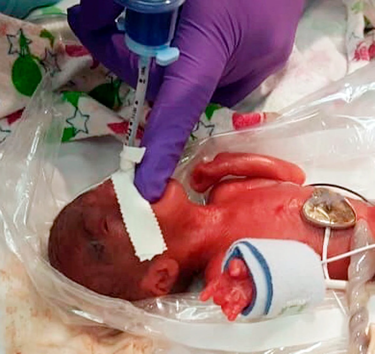 The girl was born 23 weeks and three days into her mother’s 40-week pregnancy.