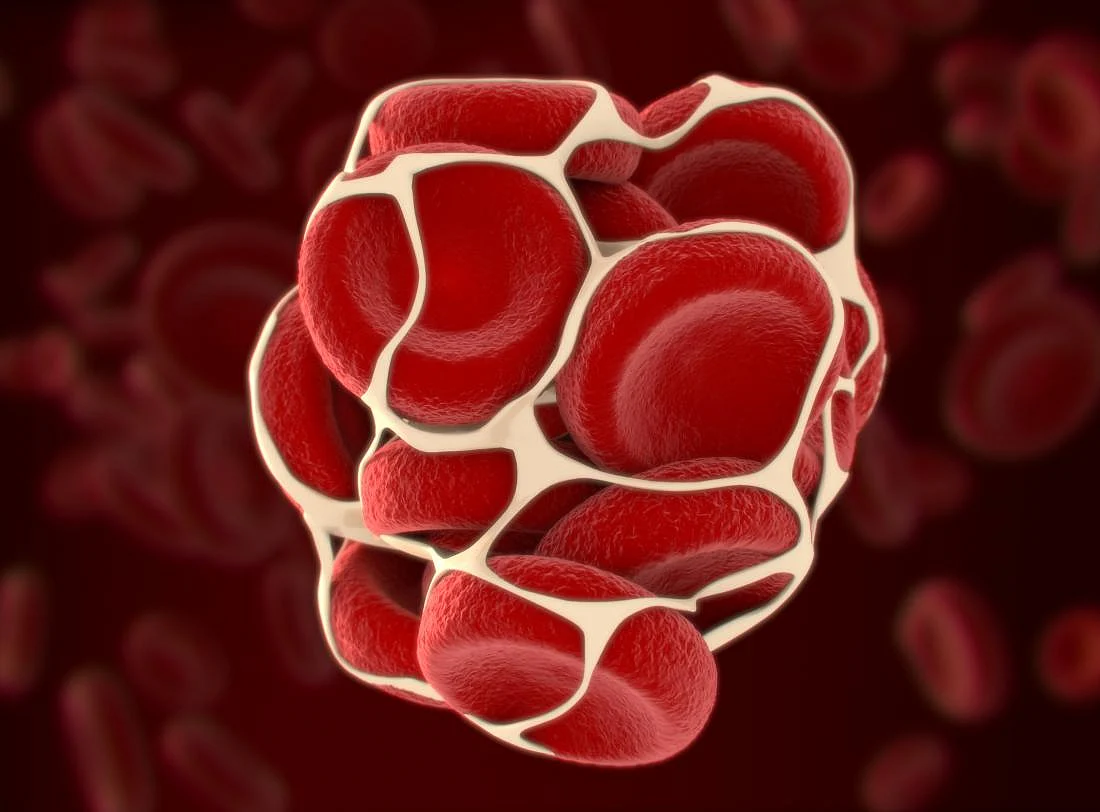Deep Vein Thrombosis occurs due to the formation of clots in one or more veins in the body.