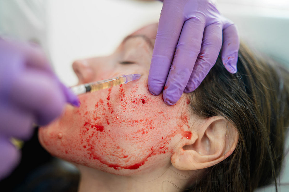 Two People Reportedly Got HIV After ‘Vampire Facial’ at Spa in US
