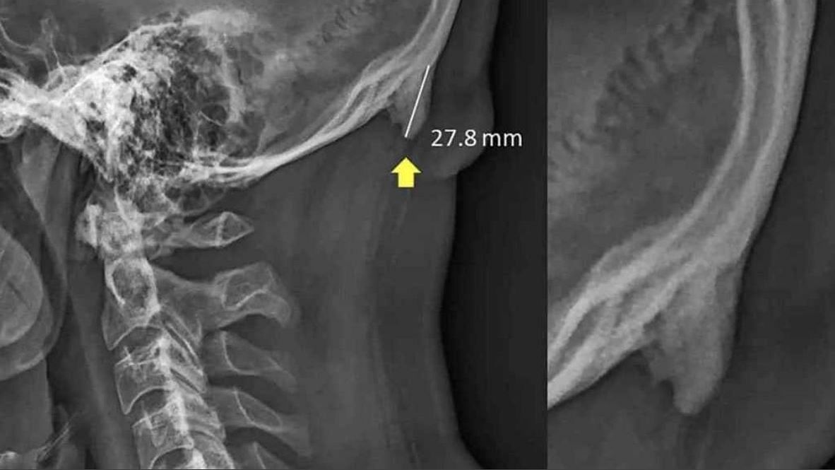 Young adults who have horn-like spurs might have strained their neck since childhood, say scientists.