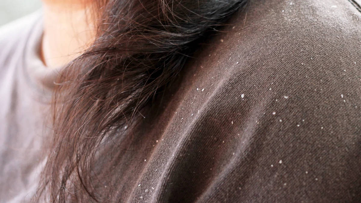 Irregular washing of hair may aggravate the situation.