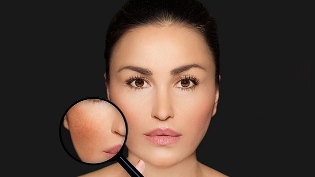 What is hyperpigmentation and how can you tackle/avoid it? Find out here