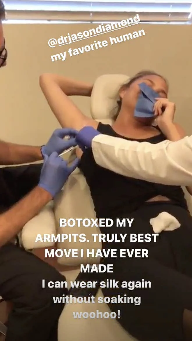 Chrissy Teigen getting Botox done in her armpits to prevent excess sweating