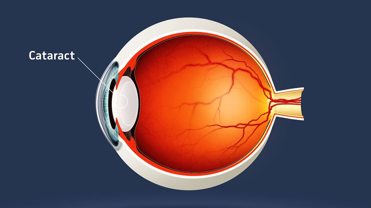Timely Cataract Surgery to Increase Road Safety: New Study