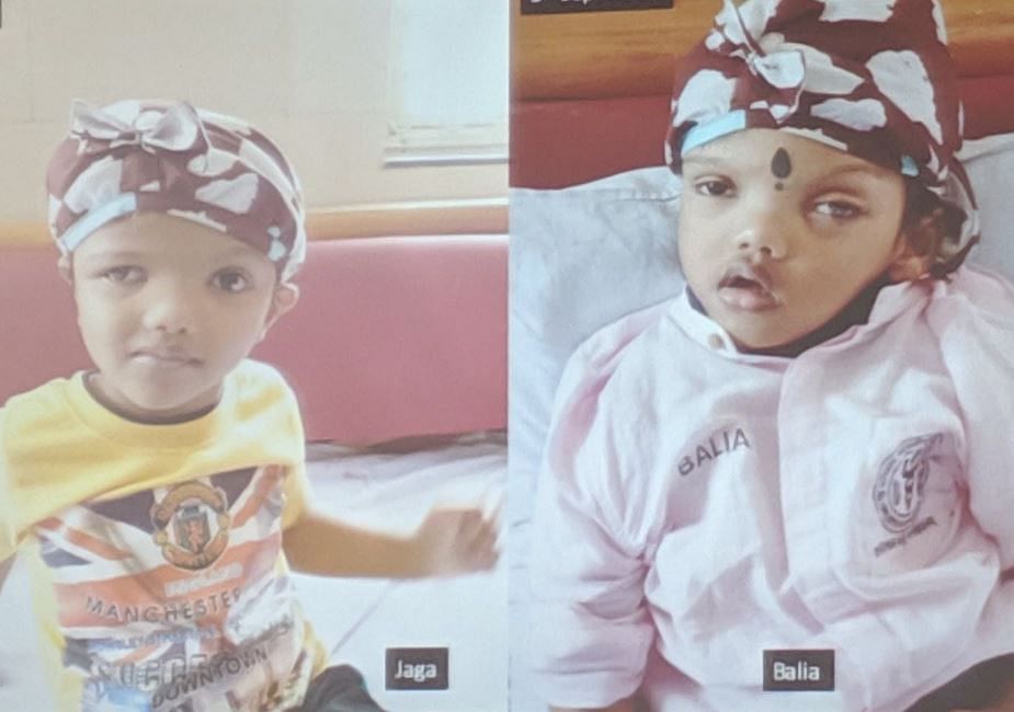 Jagga and Balia had been separated by a team of doctors at AIIMS in October 2017.