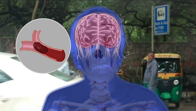 Blood Clots lead to a stroke