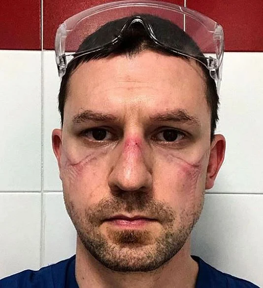 Rash, Sweat, Bruises: Wearing PPE for Hours Causing Skin Infection