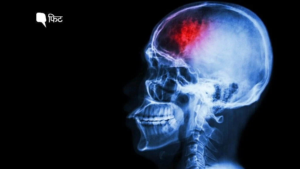 <div class="paragraphs"><p>Stroke</p></div>