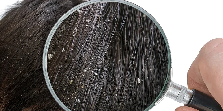 7 Tips to Combat Dandruff in Winters