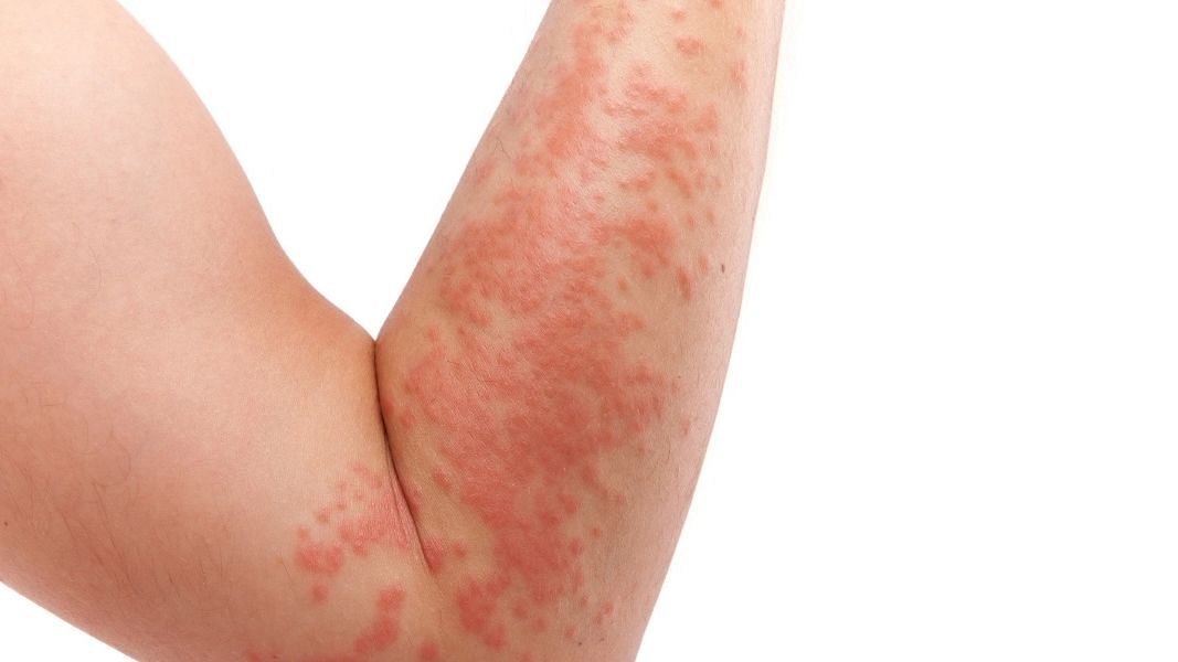 Hives Symptoms: What They Look Like