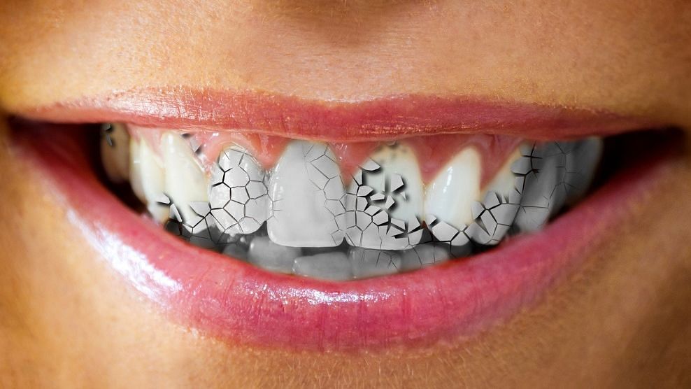 रिसर्चर्स ने चेतावनी दी है कि दांतों को चमकाने वाले प्रोडक्ट्स भले ही आपकी मुस्कुराहट को खूबसूरत बना दें, लेकिन ये आपके दांतों को नुकसान पहुंचाने की वजह बन सकते हैं.