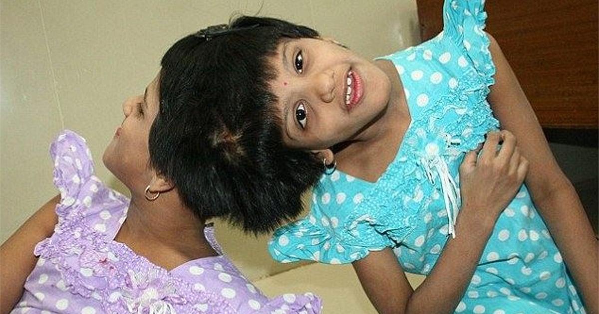 Conjoined Twins, Broken Promises Veena and Vani’s Painful Story