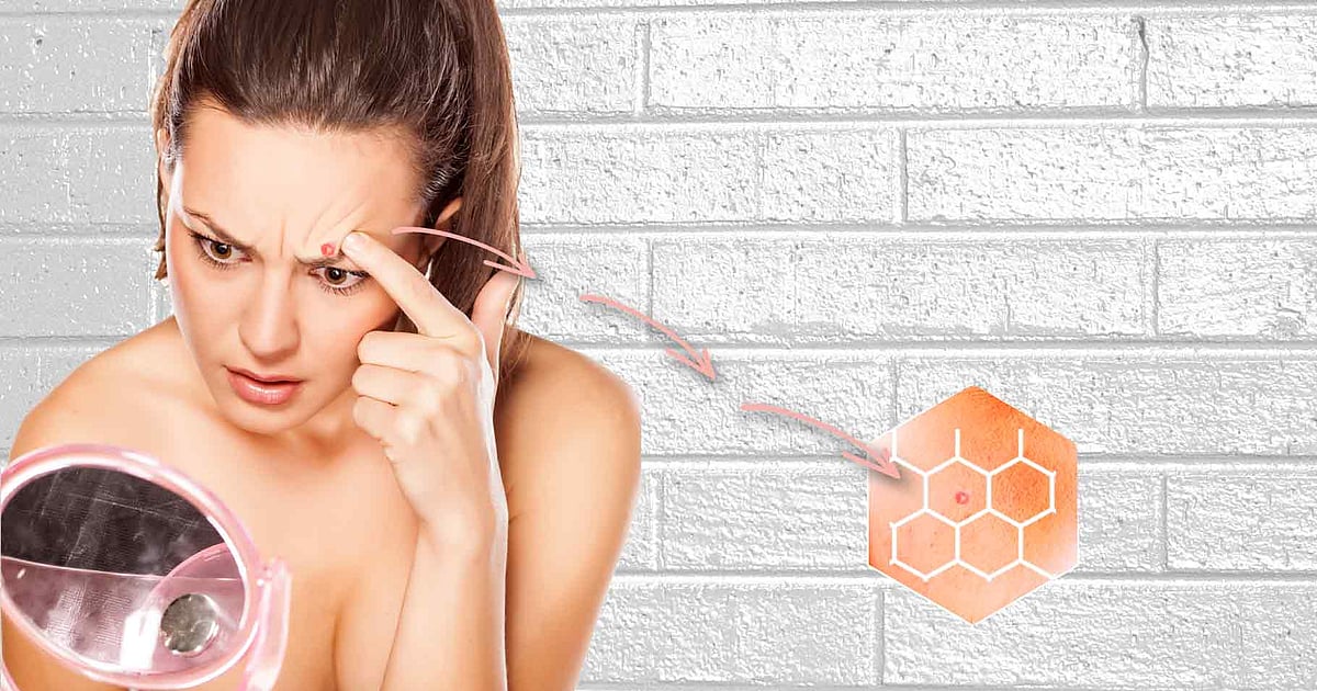 Why Do You Keep Getting Pimples at the Same Spot?