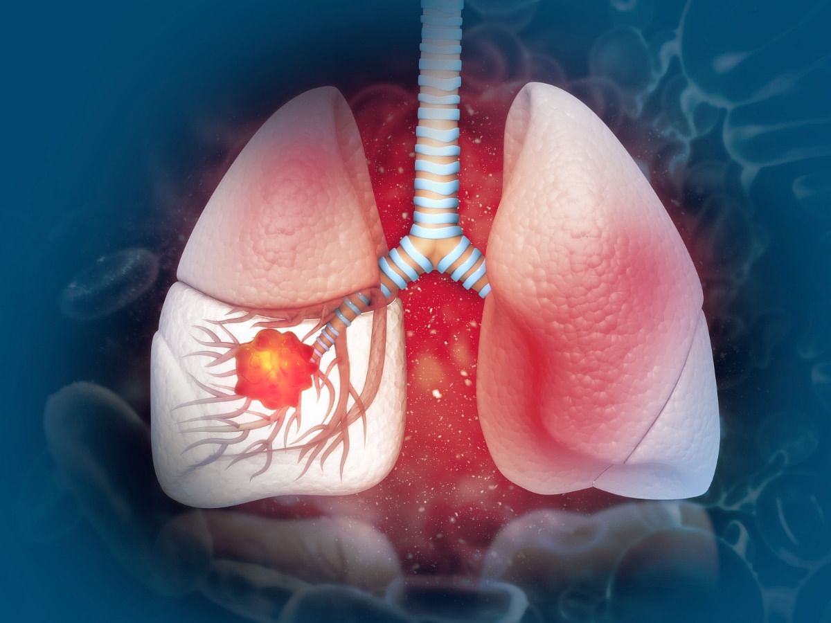 lung-cancer-types-causes-symptoms-diagnosis-stages-and-treatment