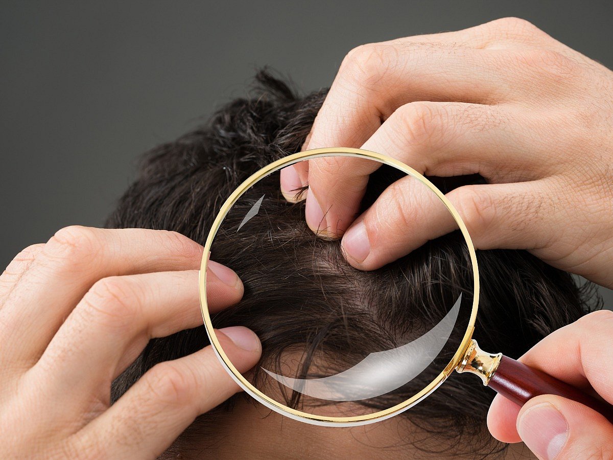 7 Home Remedies for Scalp Psoriasis