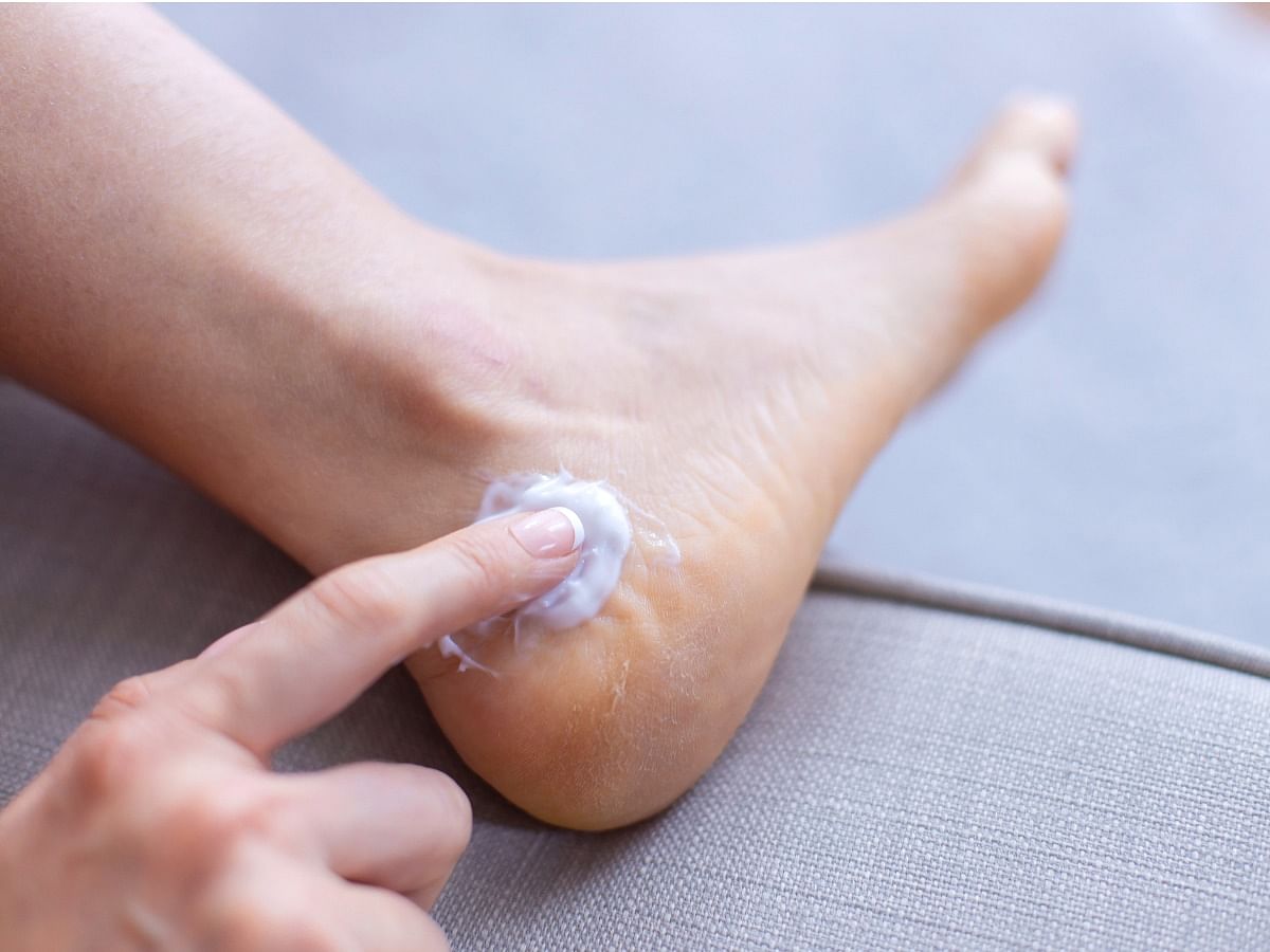 Cracked feet deals treatment