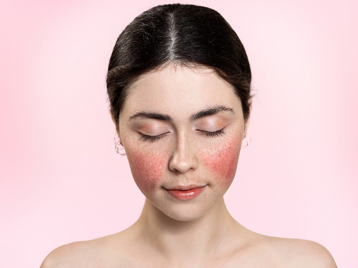 Rosacea Causes, Symptoms, Diagnosis, and Treatment