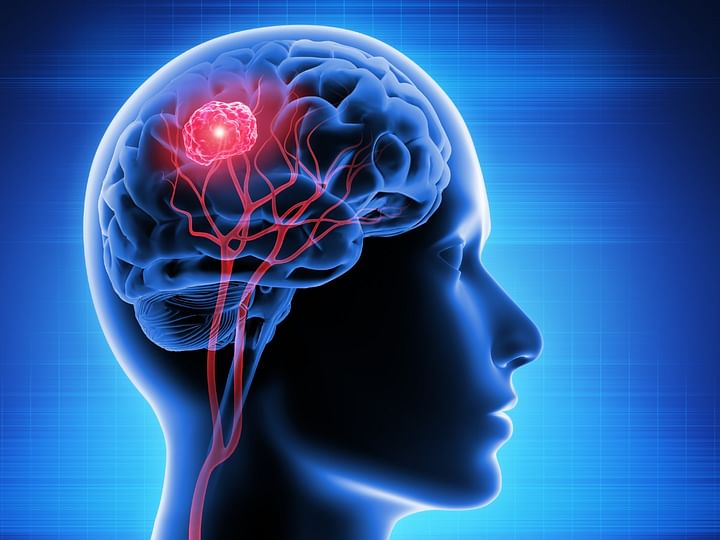 Brain Tumour Symptoms Causes Diagnosis And Treatment